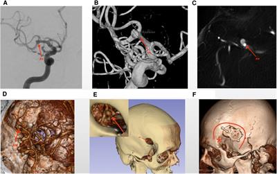 Virtual reality guided focused Sylvian approach for clipping unruptured middle cerebral artery aneurysms